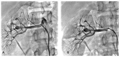 Case Report: Combination of Pressure Guidewire and Optical Coherence Tomography-Guided Drug-Coated Balloon Revascularization for Renal Artery Fibromuscular Dysplasia